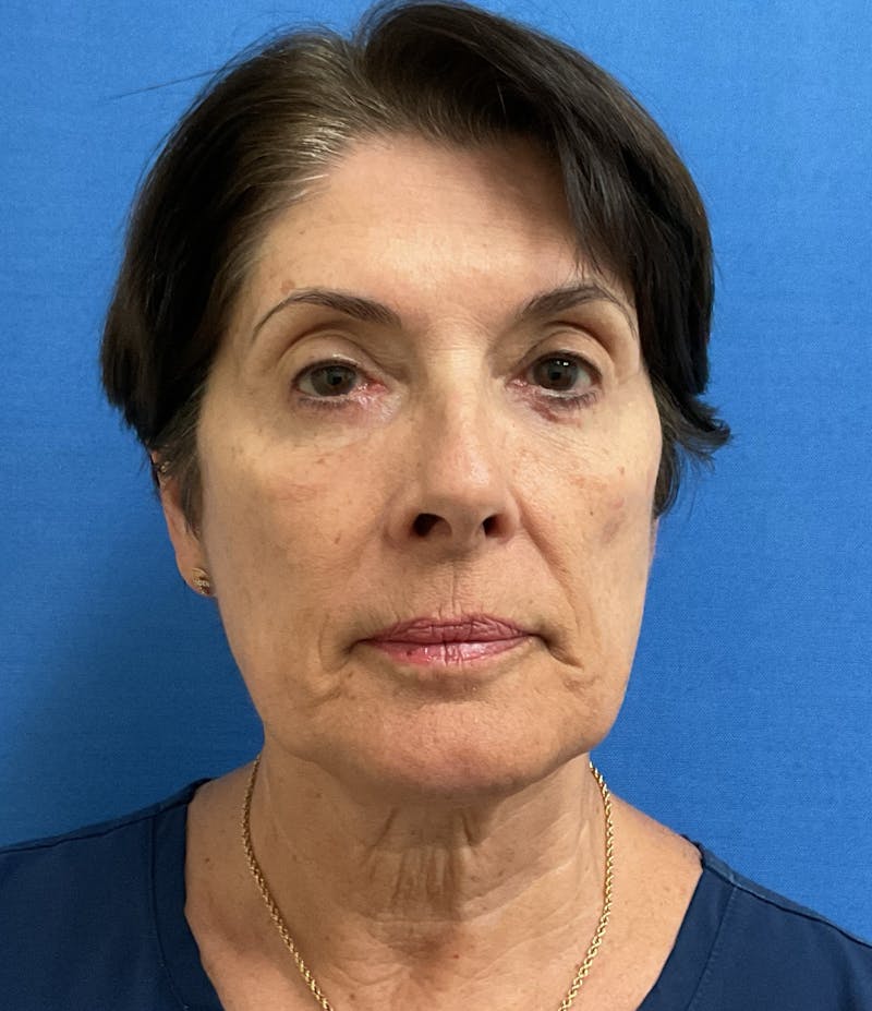 Dr. Abby Threet Before & After Gallery - Patient 246089 - Image 2