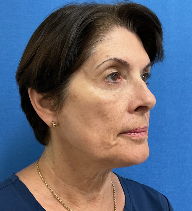 Dr. Abby Threet Before & After Gallery - Patient 246089 - Image 4