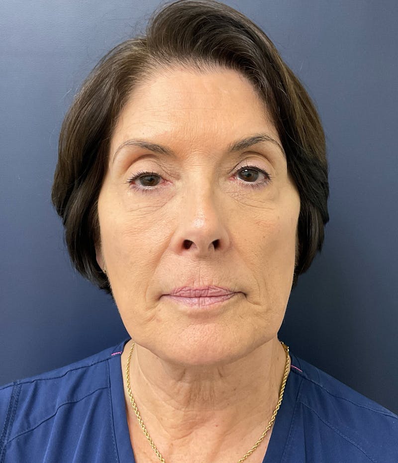 Dr. Abby Threet Before & After Gallery - Patient 246089 - Image 1
