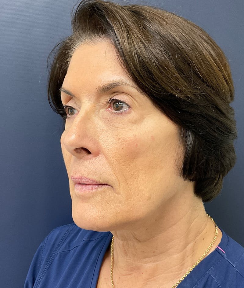Dr. Abby Threet Before & After Gallery - Patient 246089 - Image 5