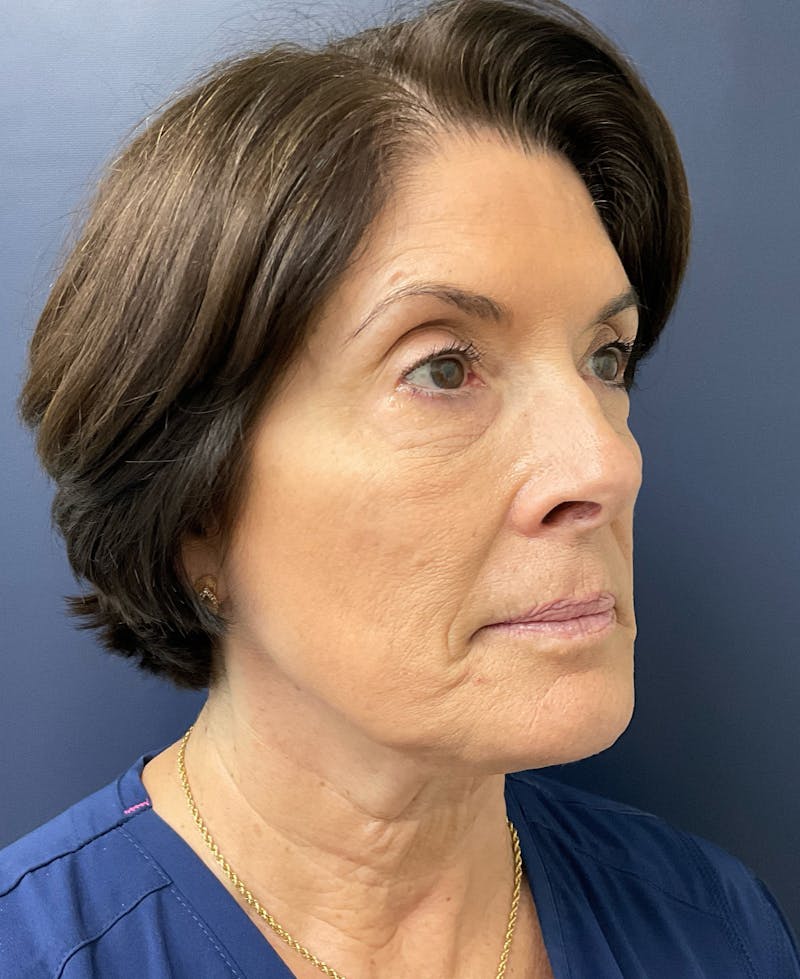 Dr. Abby Threet Before & After Gallery - Patient 246089 - Image 3