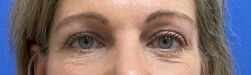 Dr. Abby Threet Before & After Gallery - Patient 266081 - Image 2