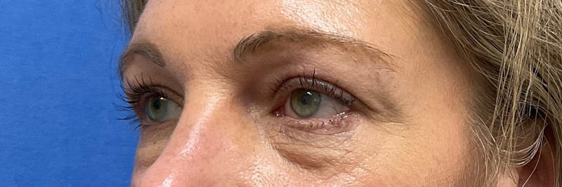 Dr. Abby Threet Before & After Gallery - Patient 266081 - Image 5