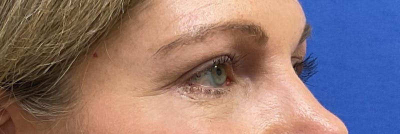 Dr. Abby Threet Before & After Gallery - Patient 266081 - Image 4