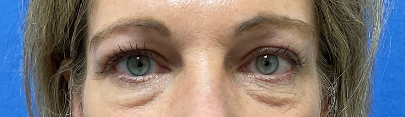 Dr. Abby Threet Before & After Gallery - Patient 266081 - Image 1
