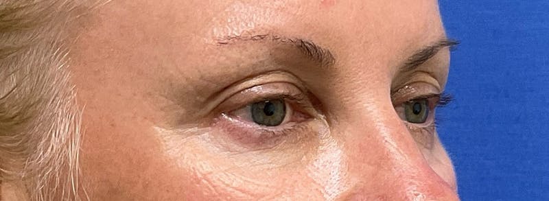 Dr. Ellen Hancock Before & After Gallery - Patient 122465 - Image 3