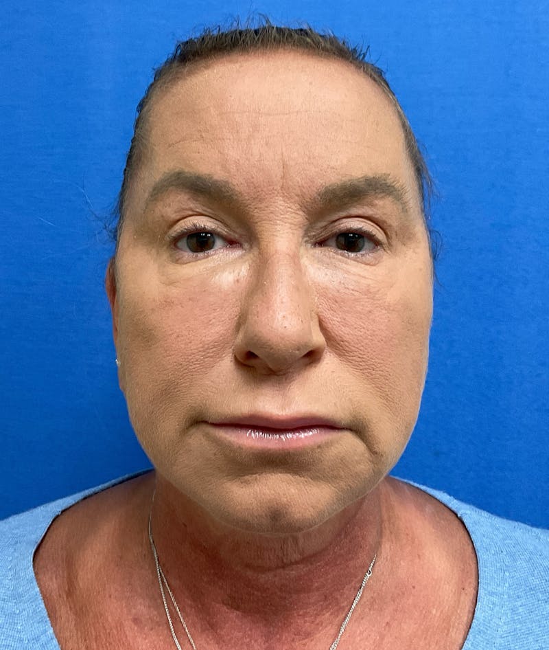 Dr. Matthew Mitchell Before & After Gallery - Patient 147728 - Image 2