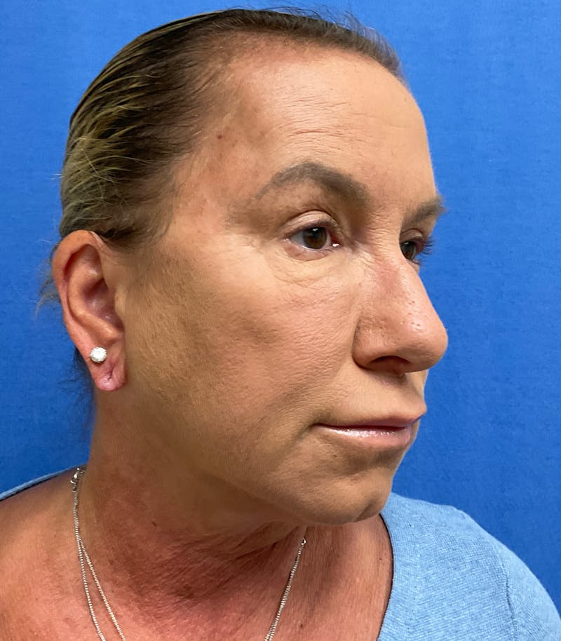 Dr. Matthew Mitchell Before & After Gallery - Patient 147728 - Image 4