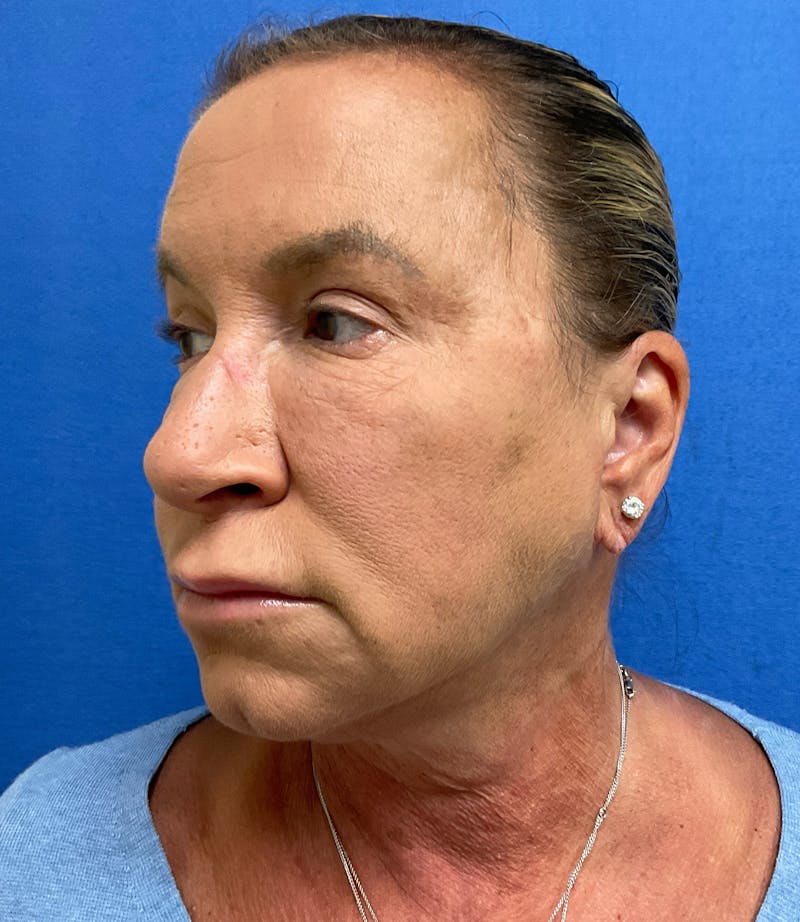 Dr. Matthew Mitchell Before & After Gallery - Patient 147728 - Image 6