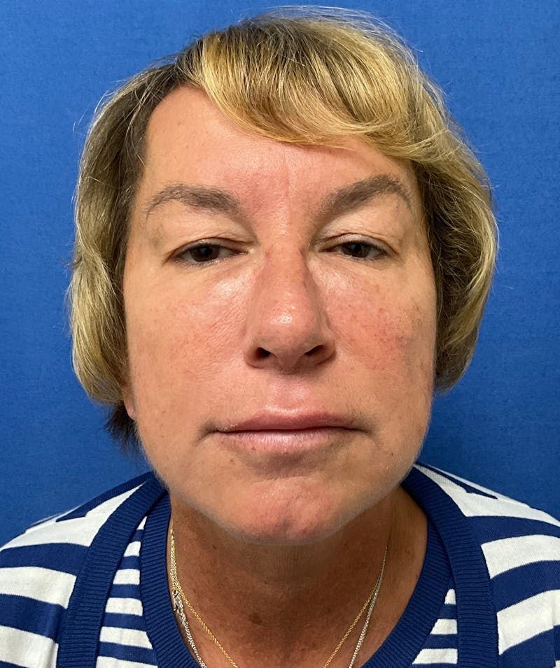 Dr. Matthew Mitchell Before & After Gallery - Patient 147728 - Image 1