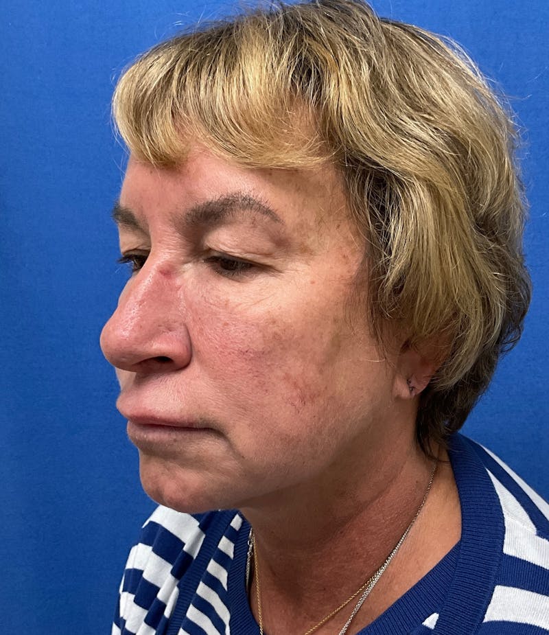 Dr. Matthew Mitchell Before & After Gallery - Patient 147728 - Image 5
