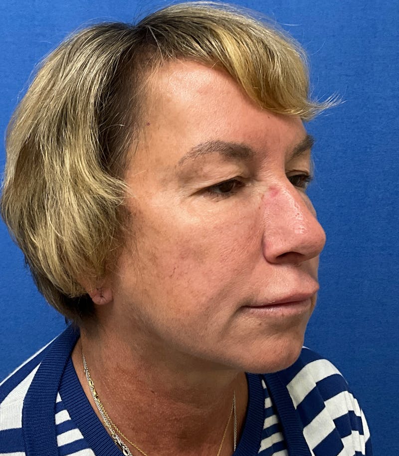 Dr. Matthew Mitchell Before & After Gallery - Patient 147728 - Image 3
