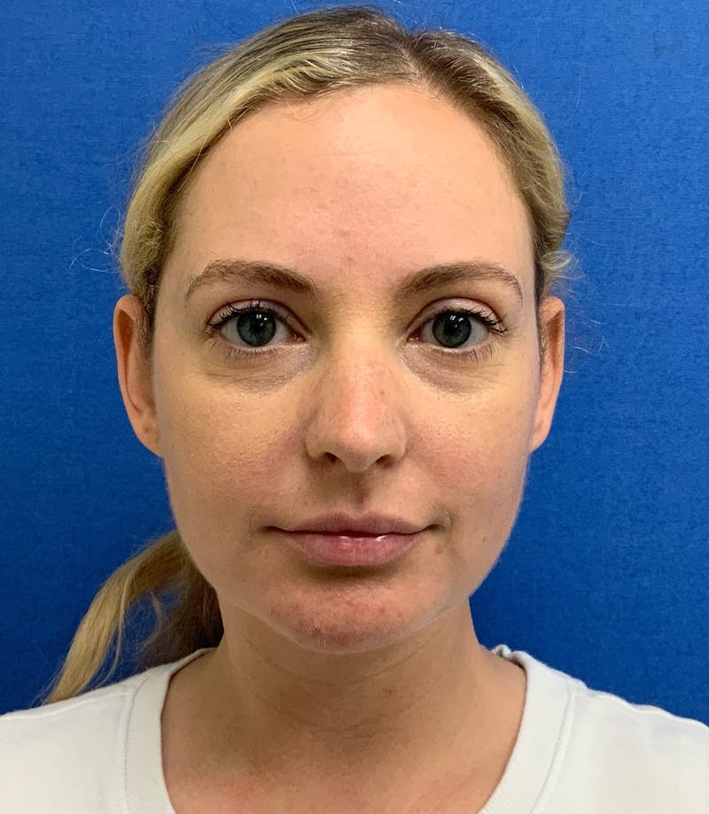 Dr. Matthew Mitchell Before & After Gallery - Patient 850968 - Image 2