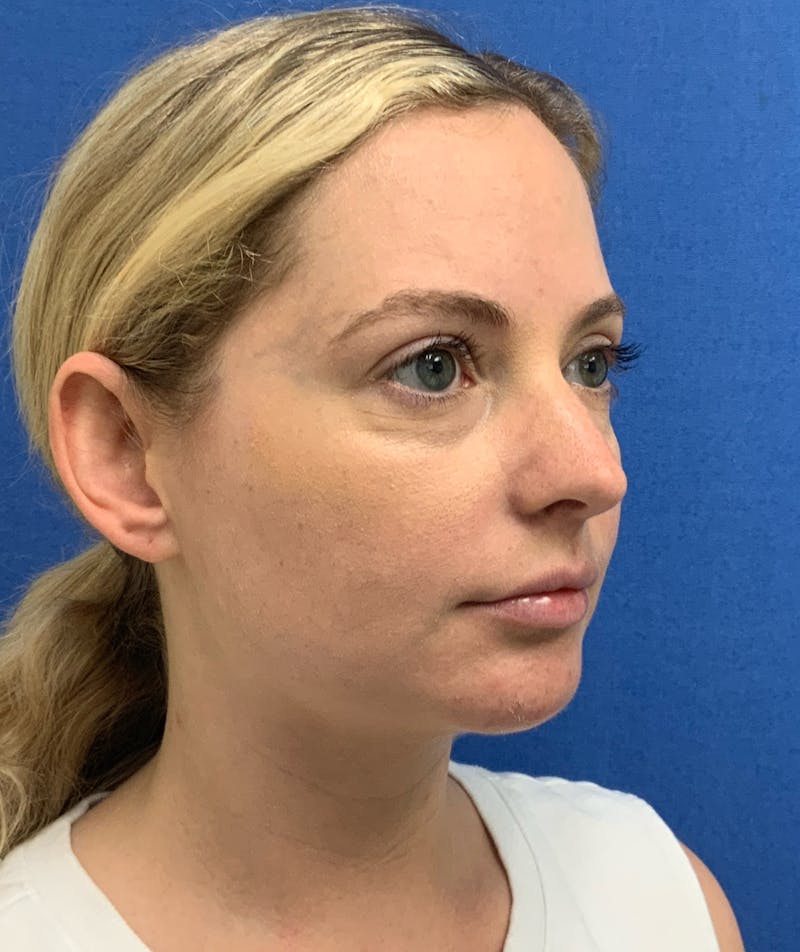 Dr. Matthew Mitchell Before & After Gallery - Patient 850968 - Image 4