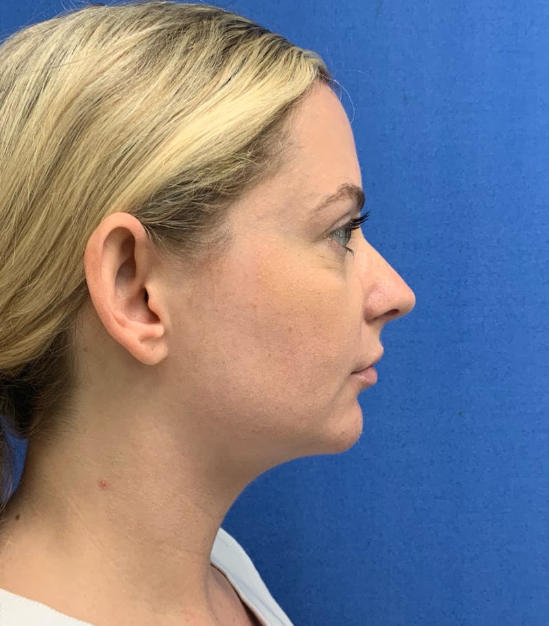Dr. Matthew Mitchell Before & After Gallery - Patient 850968 - Image 6