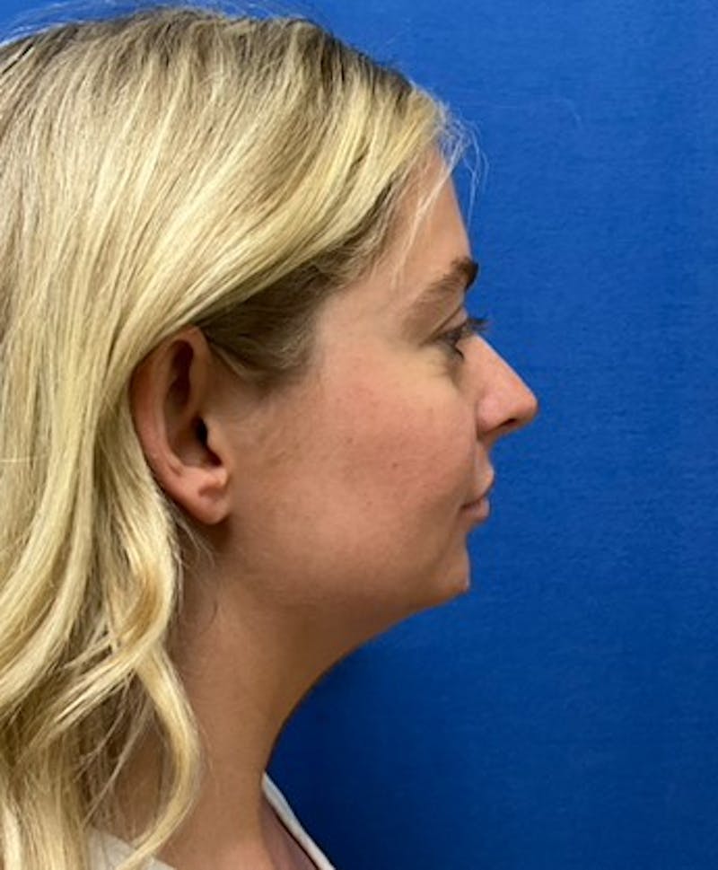 Dr. Matthew Mitchell Before & After Gallery - Patient 850968 - Image 5
