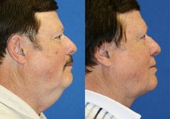 before neck lift photo