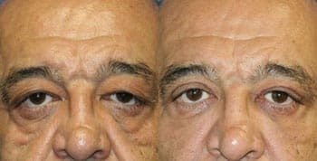 Male facial after photo