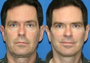 male facelift results