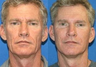 male face lift before and after