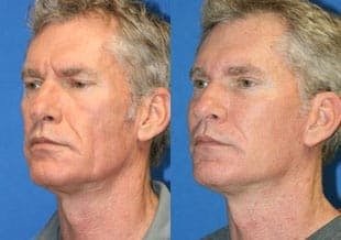 male face lift before and after