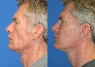 male face lift before and after