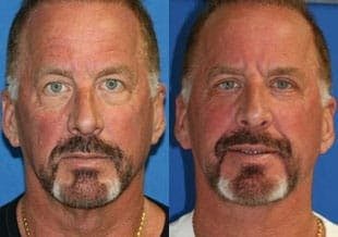 male face lift before and after