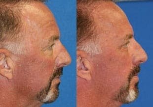 male face lift before and after