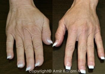 Hand filler before and after