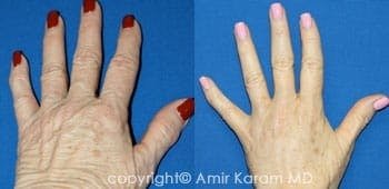 Hand Rejuvenation San Diego