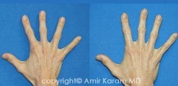 Hand Rejuvenation San Diego