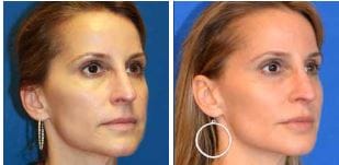 patient that received fillers