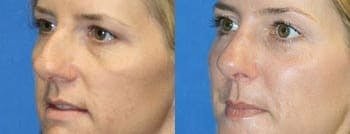 patient that received resurfacing treatment