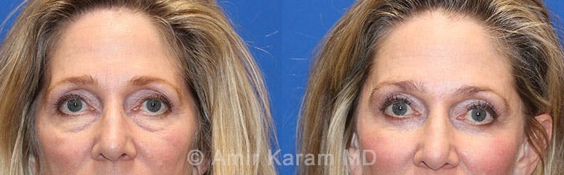 Eye Rejuvenation Before & After Gallery - Patient 71687774 - Image 1