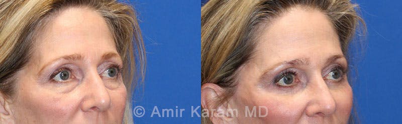 Eye Rejuvenation Before & After Gallery - Patient 71687774 - Image 2