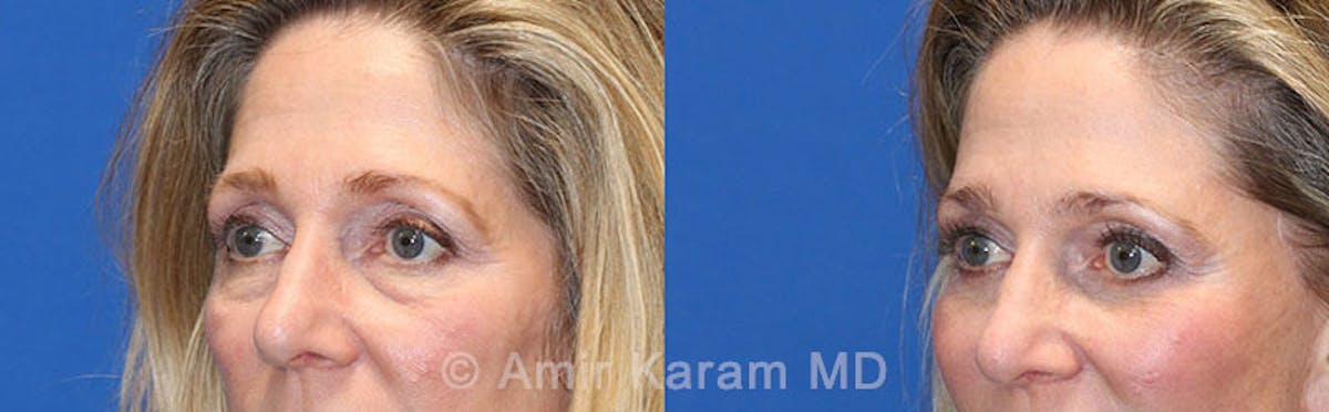 Eye Rejuvenation Before & After Gallery - Patient 71687774 - Image 3