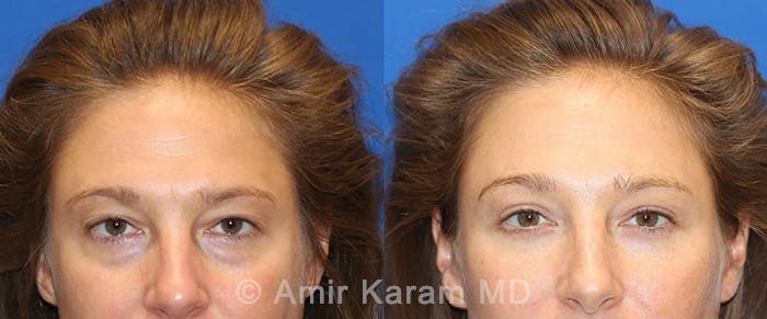 Eye Rejuvenation Before & After Gallery - Patient 71687775 - Image 1