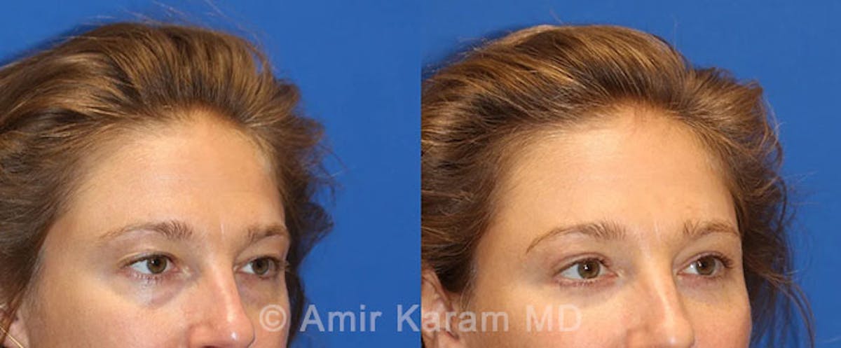 Eye Rejuvenation Before & After Gallery - Patient 71687775 - Image 2