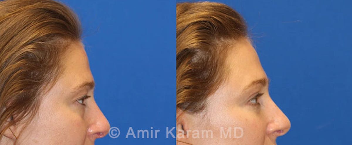 Eye Rejuvenation Before & After Gallery - Patient 71687775 - Image 3