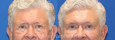 Eye Rejuvenation Before & After Gallery - Patient 71687791 - Image 1