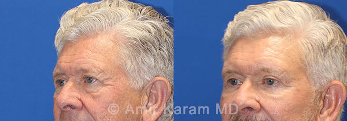 Eye Rejuvenation Before & After Gallery - Patient 71687791 - Image 2