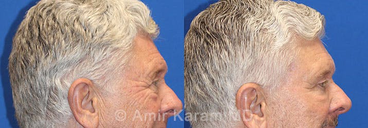 Eye Rejuvenation Before & After Gallery - Patient 71687791 - Image 3