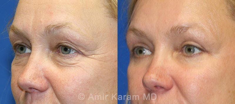Eye Rejuvenation Before & After Gallery - Patient 71687792 - Image 1