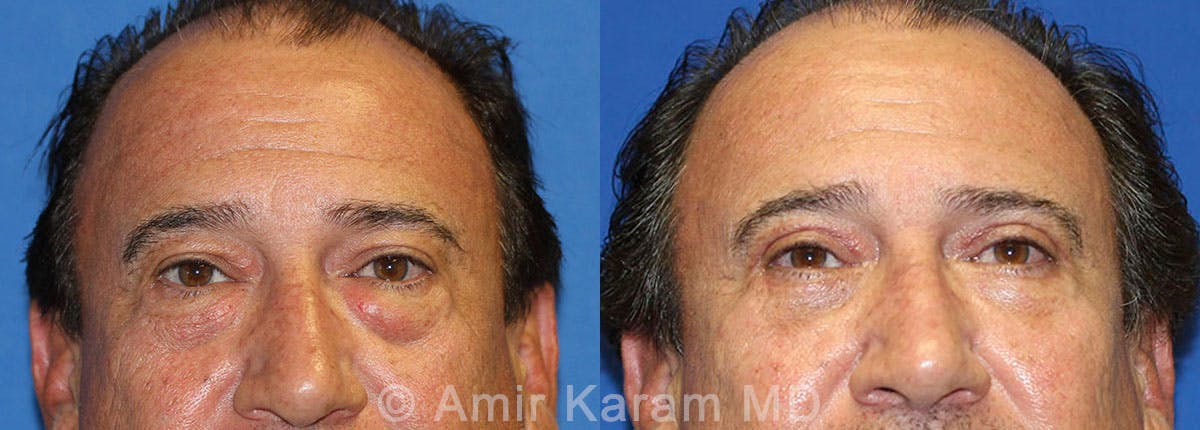Eye Rejuvenation Before & After Gallery - Patient 71687795 - Image 1
