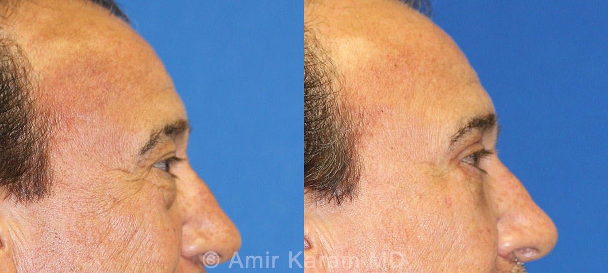 Eye Rejuvenation Before & After Gallery - Patient 71687795 - Image 2