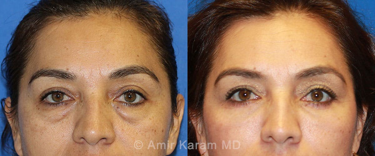 Eye Rejuvenation Before & After Gallery - Patient 71687798 - Image 1