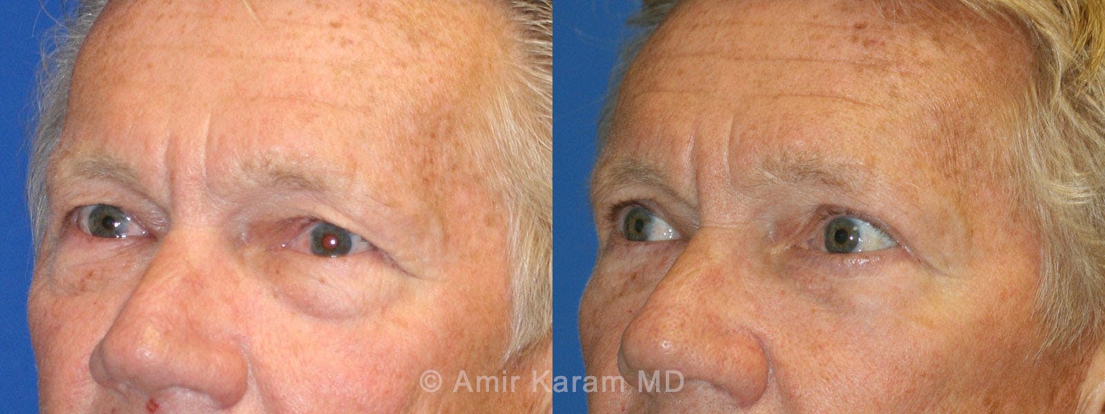 Eye Rejuvenation Before & After Gallery - Patient 71687808 - Image 1
