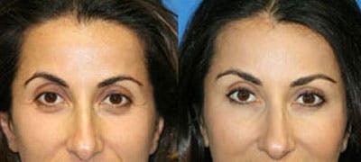 Eye Rejuvenation Before & After Gallery - Patient 71700134 - Image 1