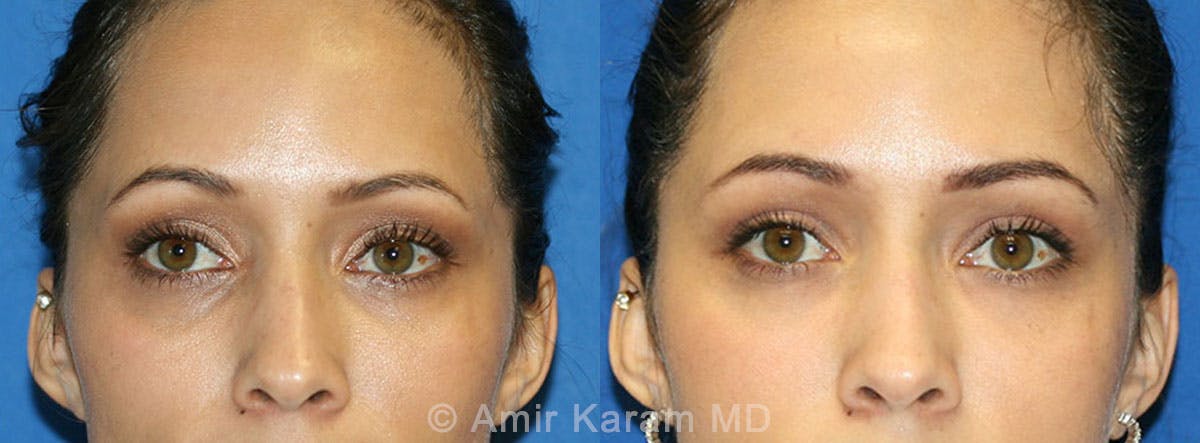Eye Rejuvenation Before & After Gallery - Patient 71700139 - Image 1