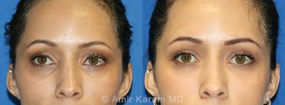 Eye Rejuvenation Before & After Gallery - Patient 71700139 - Image 1